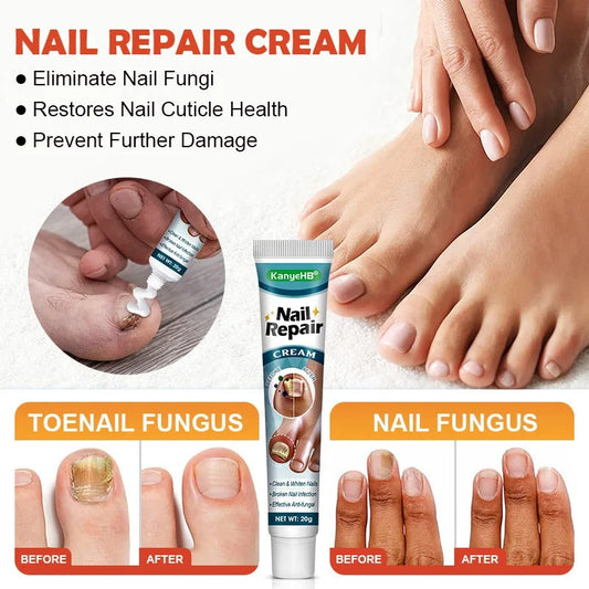 20g Crème de Soin des Ongles, Nourrissant et Renforce pour Ongles, Réparation D’ongle Pour Les Ongles Décolorés Épaissis Émiettés Cassés